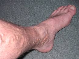 Varicose Veins in Oakbrook: More Than Just an Issue of Appearance