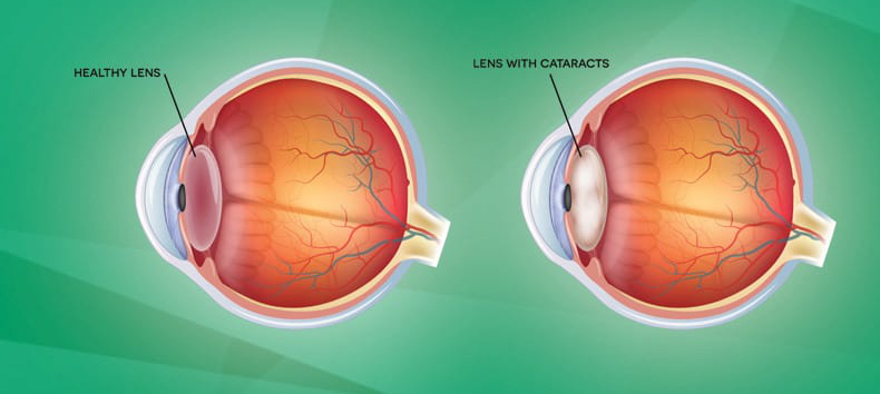 What to Expect from Cataract Treatment